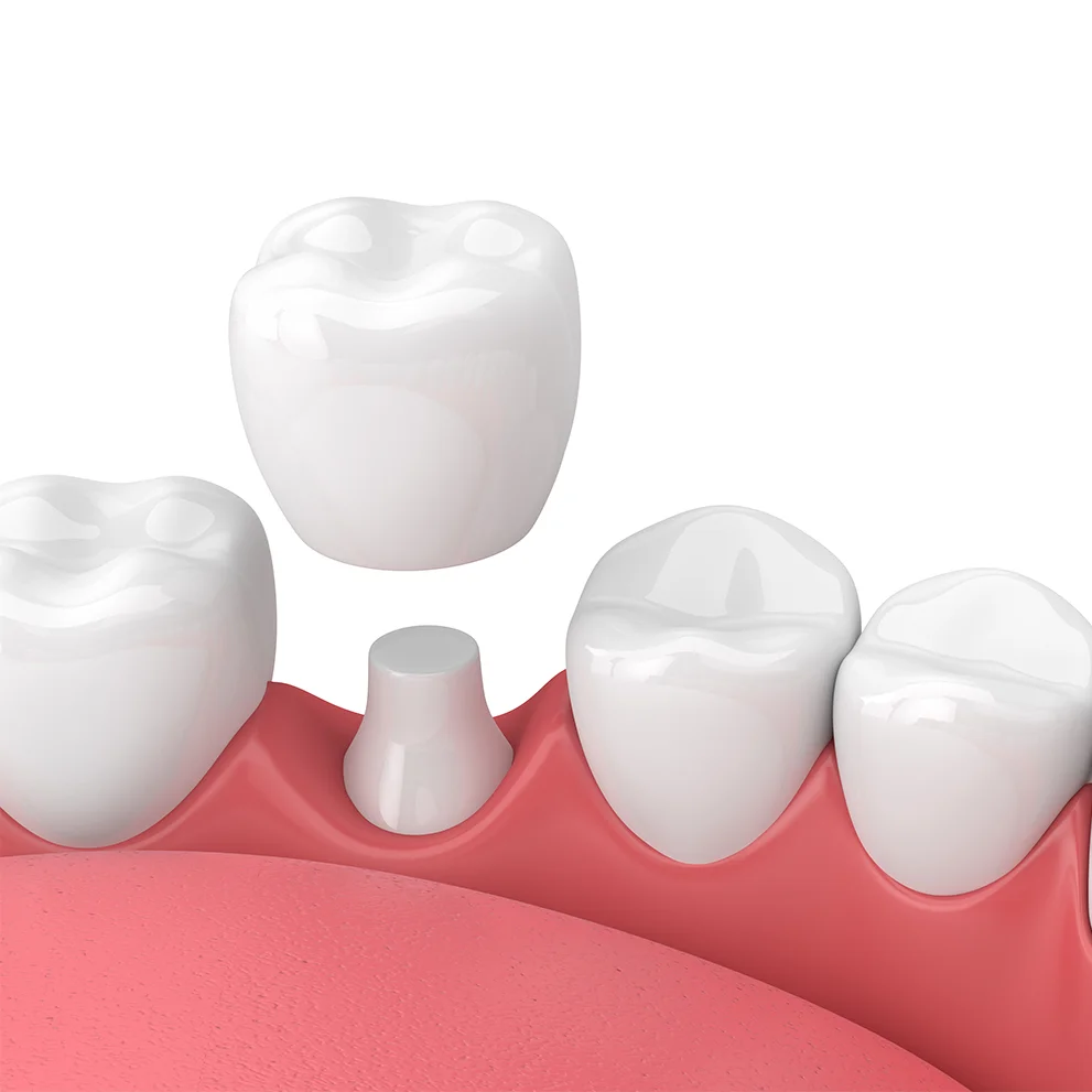 3D illustration of a dental crown placement showing a tooth-shaped crown being positioned over a prepared tooth stub between two natural teeth.